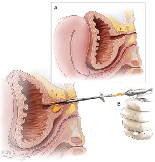 Urethral Bulking for Stress Urinary Incontinence - Your Pelvic Floor