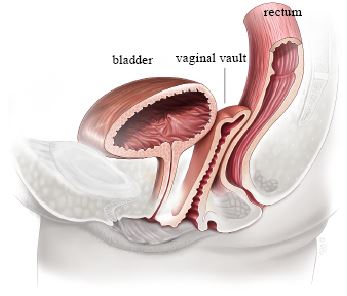 Vaginal Hysterectomy for Prolapse - Your Pelvic Floor