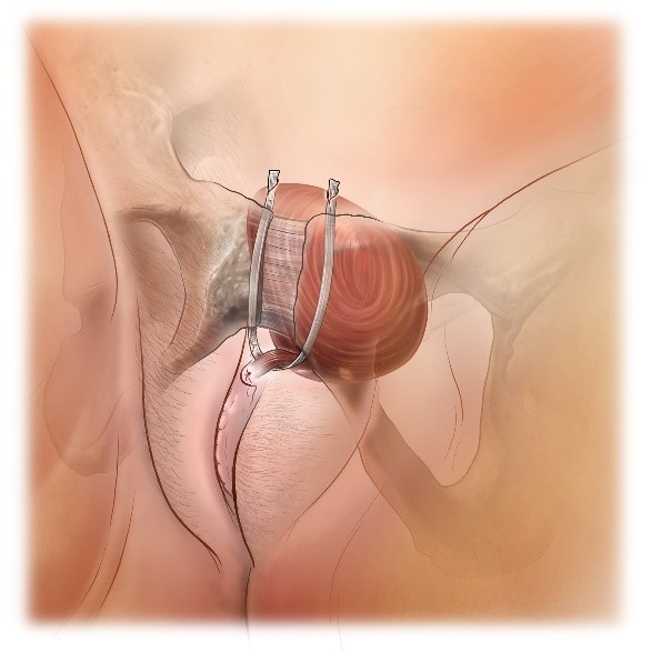 Urethral Sling Surgery: What to Expect at Home