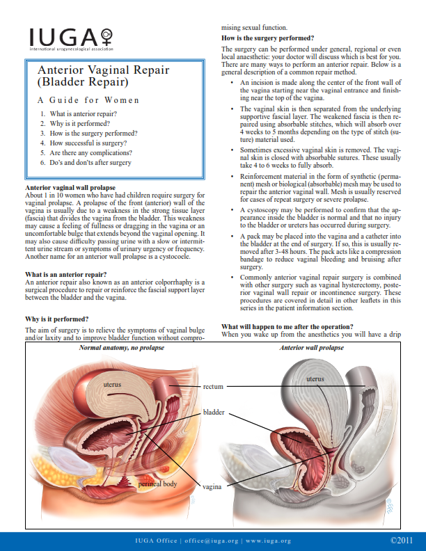 Reparación o Plastía Vaginal Anterior (Reparación de Cistocele)