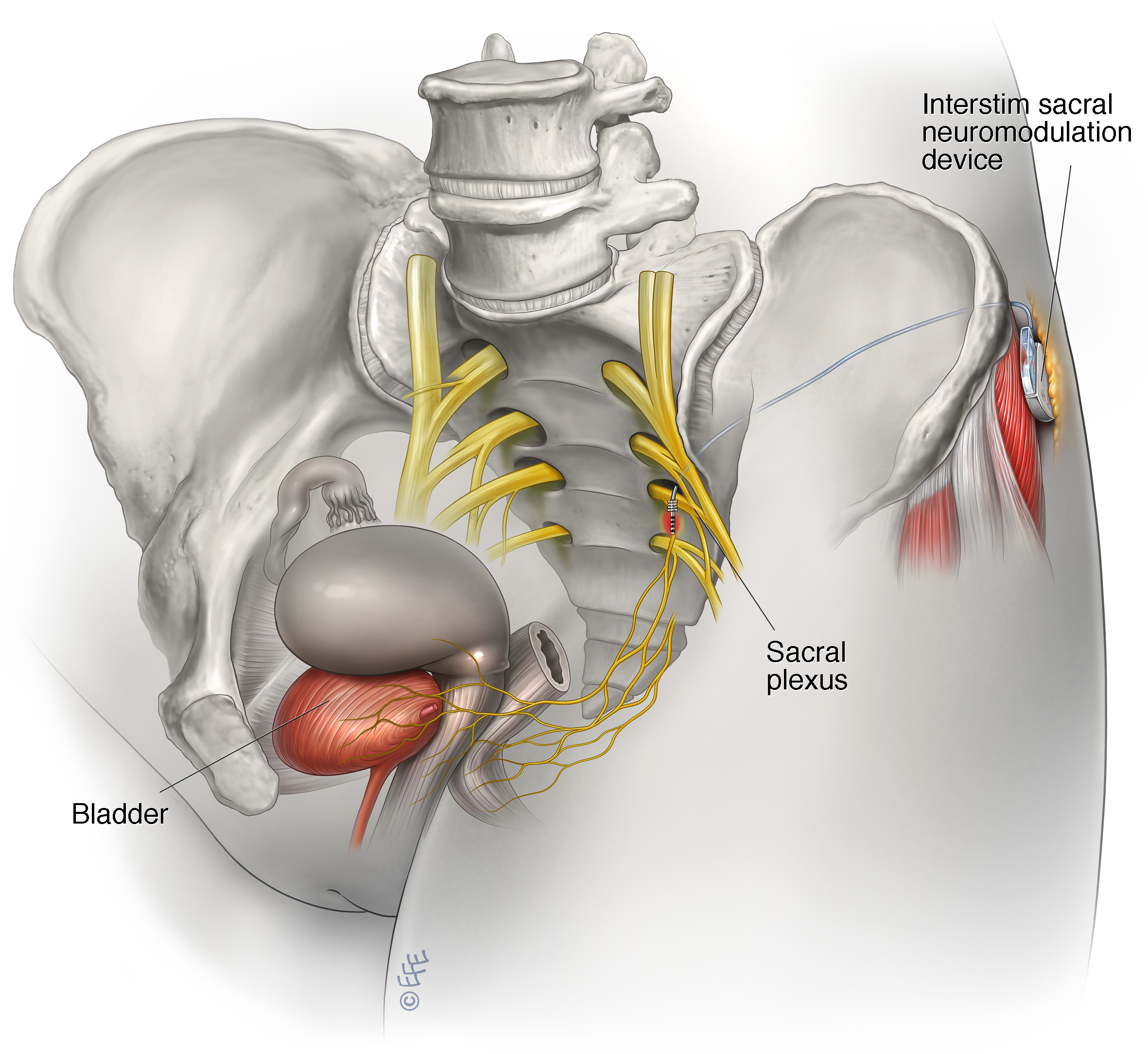 InterStim Therapy for Bladder Control 