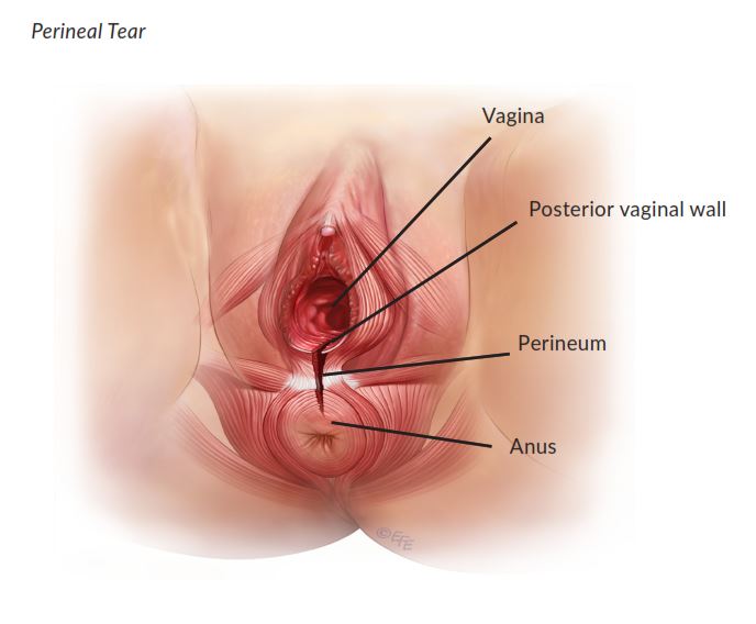 This is a type of tear sustained during vaginal childbirth which involves t...