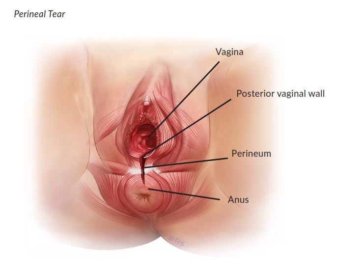 How To Treat Vaginal Tears