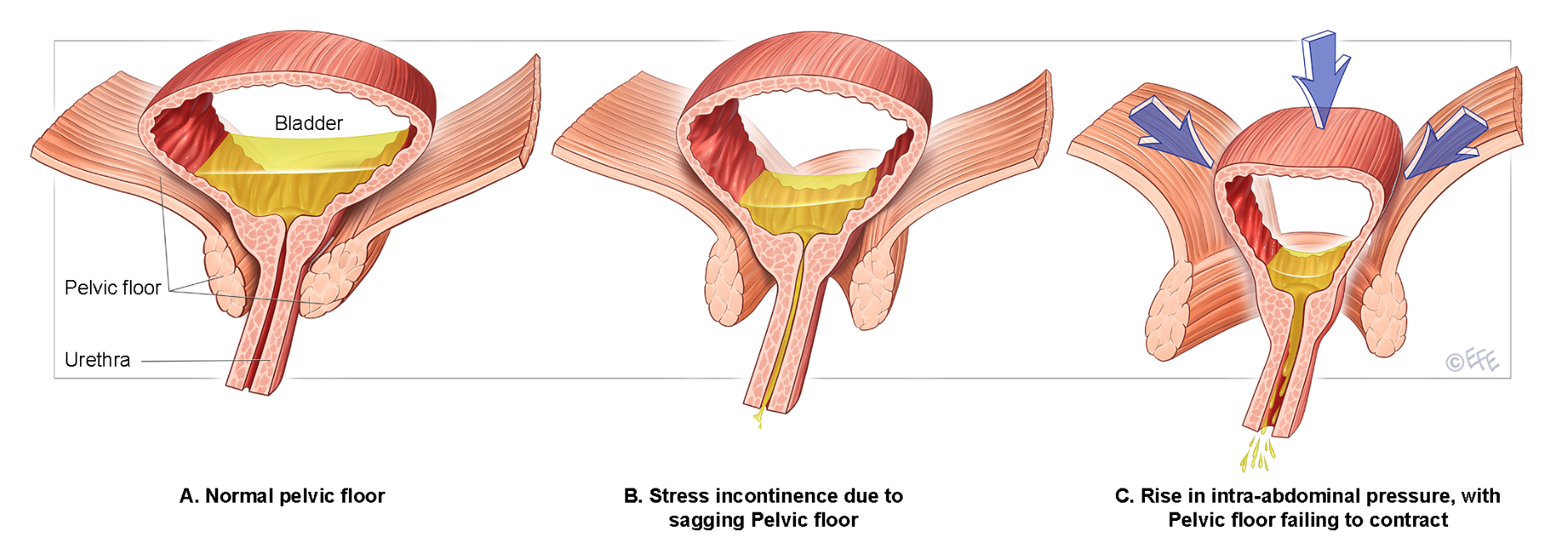 Stretch Muscle to Stop Bladder Leakage: Quick Relief Tips