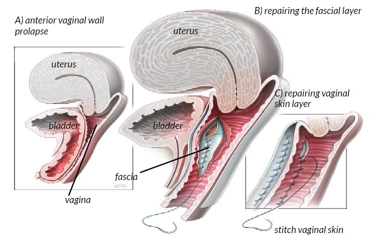 Vaginal Mesh Contraction