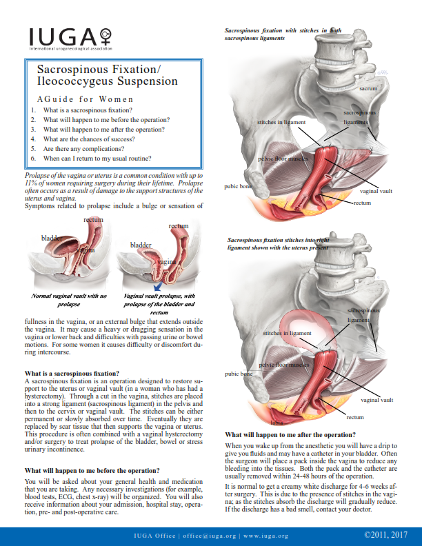 Sacrospinous Fixation/Illeococcygeus Suspension